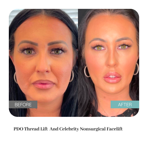 Before and after treatment result — Dr. Lanna, LC Medical Aesthetics NYC